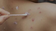 varicela